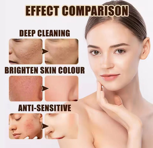 30g Acne Cream soothes, hydrates, helps regulate oil, reduces redness, and enhances skin texture with a moisturizing feel30g Acne Cream soothes, hydrates, helps regulate oil, reduces redness, and enhances skin texture with a moisturizing feelvvvvv