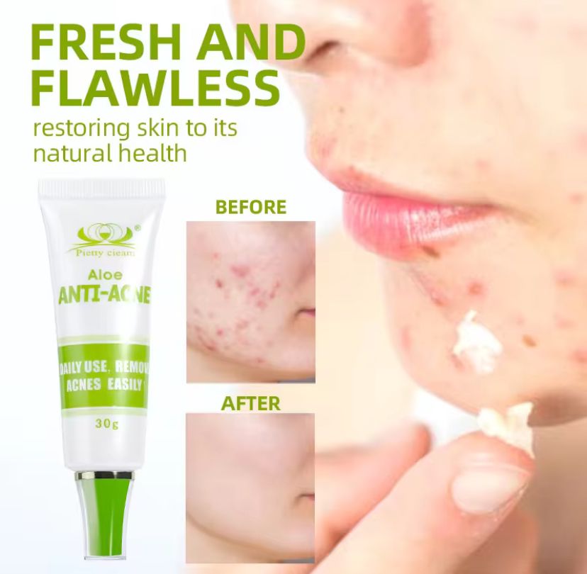 30g Acne Cream soothes, hydrates, helps regulate oil, reduces redness, and enhances skin texture with a moisturizing feel30g Acne Cream soothes, hydrates, helps regulate oil, reduces redness, and enhances skin texture with a moisturizing feelvvvvv